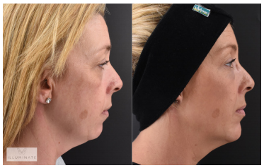 Shape & Sculpt - Treatment results